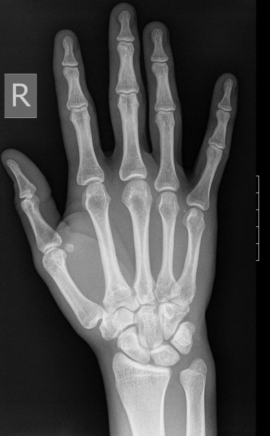 X-ray of the Right Hand